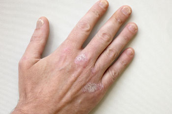 Esplode la psoriasi: un regalo della crisi 