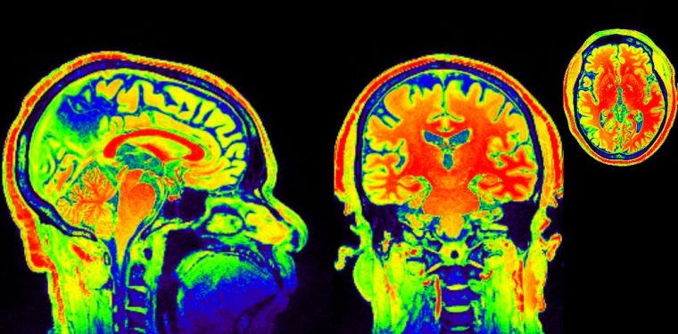 Neuro-imaging per curare l’Alzheimer