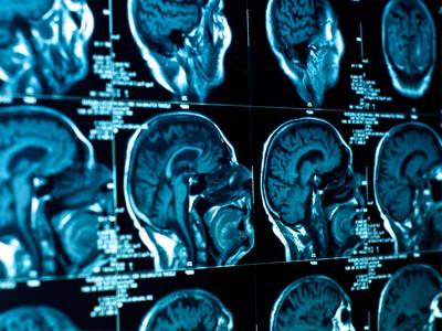 A Napoli il XV Congresso mondiale di Neuroradiologia interventistica