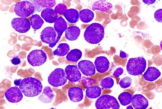 Nuova speranza di cura per la leucemia linfoblastica acuta