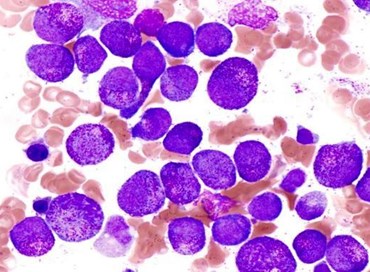 Nuova speranza di cura per la leucemia linfoblastica acuta