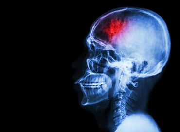 Stroke and Aneurysm Virtual Meeting