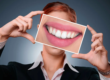 L’Opinione risponde: le faccette dentali