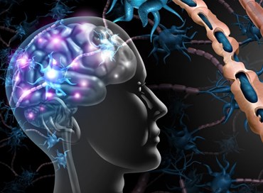 Sclerosi multipla, passi avanti nella ricerca