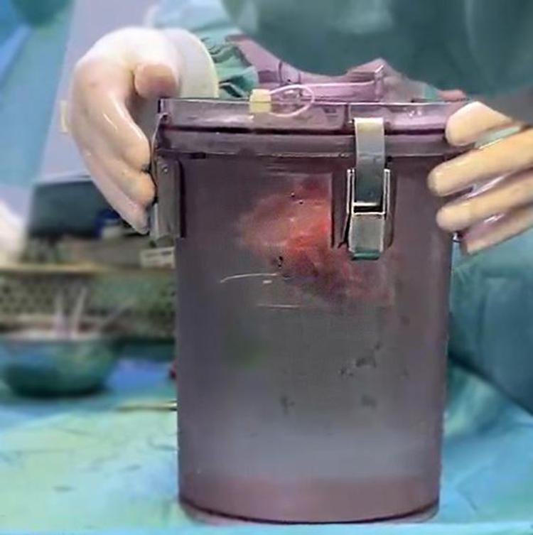 Guscio smart per un cuore in attesa di trapianto, salvo un bambino