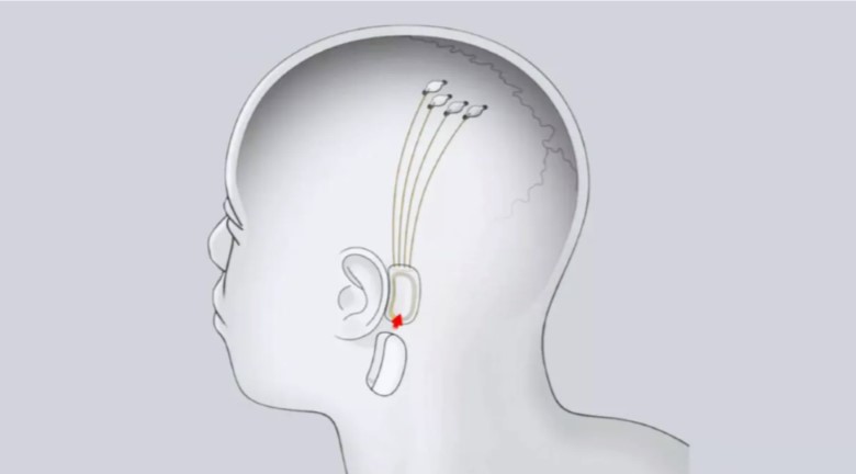 Musk presenta Neuralink: “Chip nel cervello umano entro sei mesi”