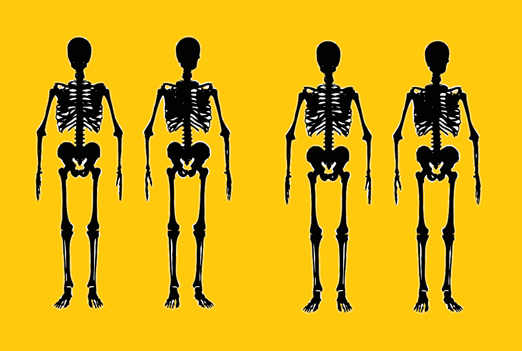 Osteoporosi: la malattia ladra di ossa (video)