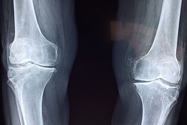 Osteoporosi: come proteggere le ossa dopo i 65 anni (Video) 